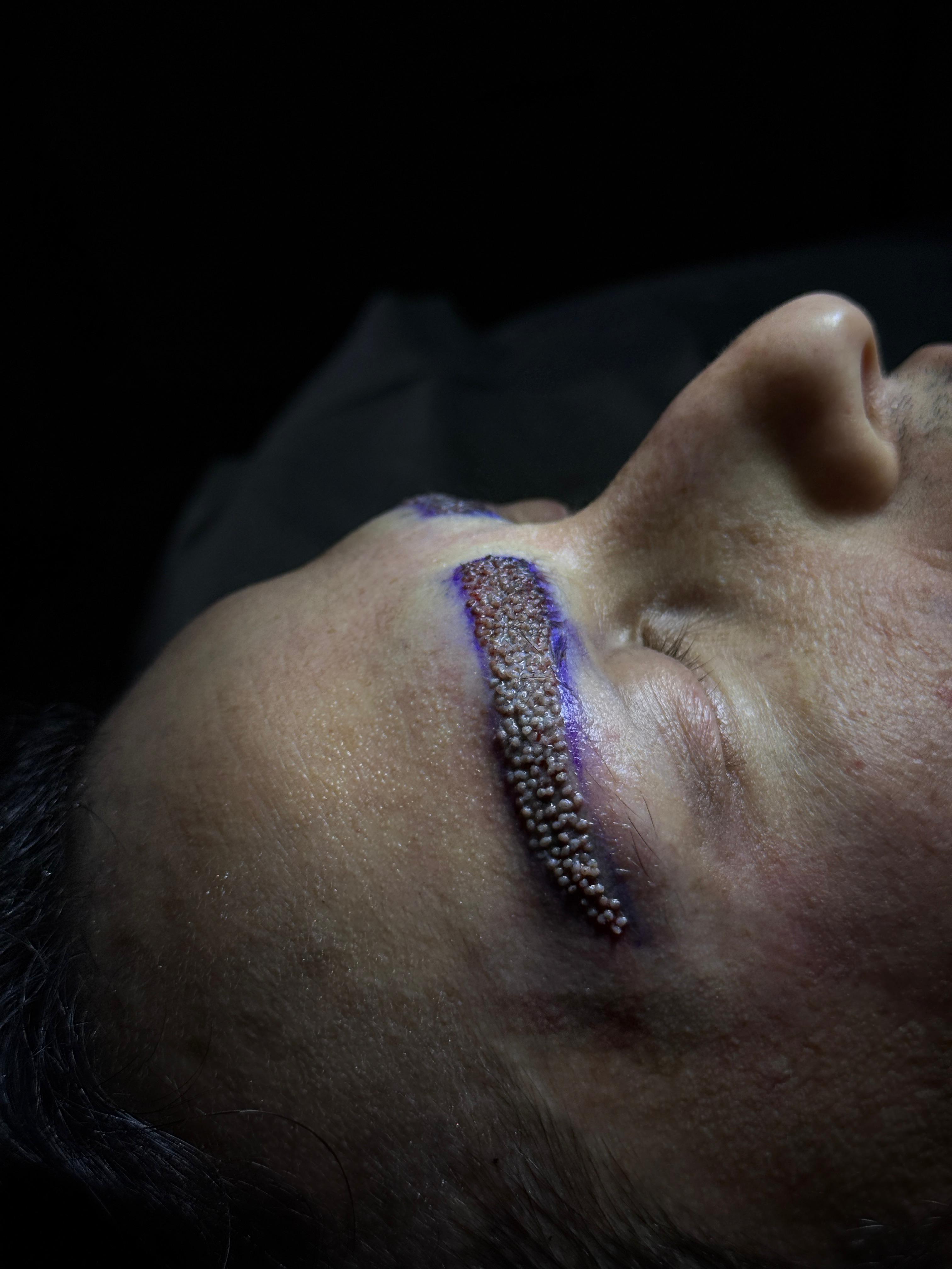 Follicle Extraction Process