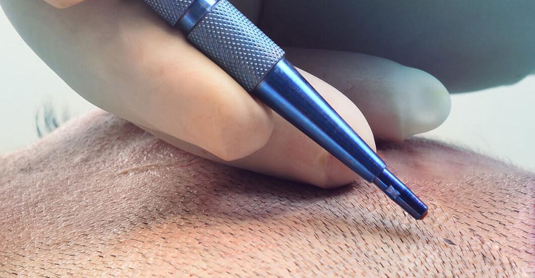 FUE Extraction Process