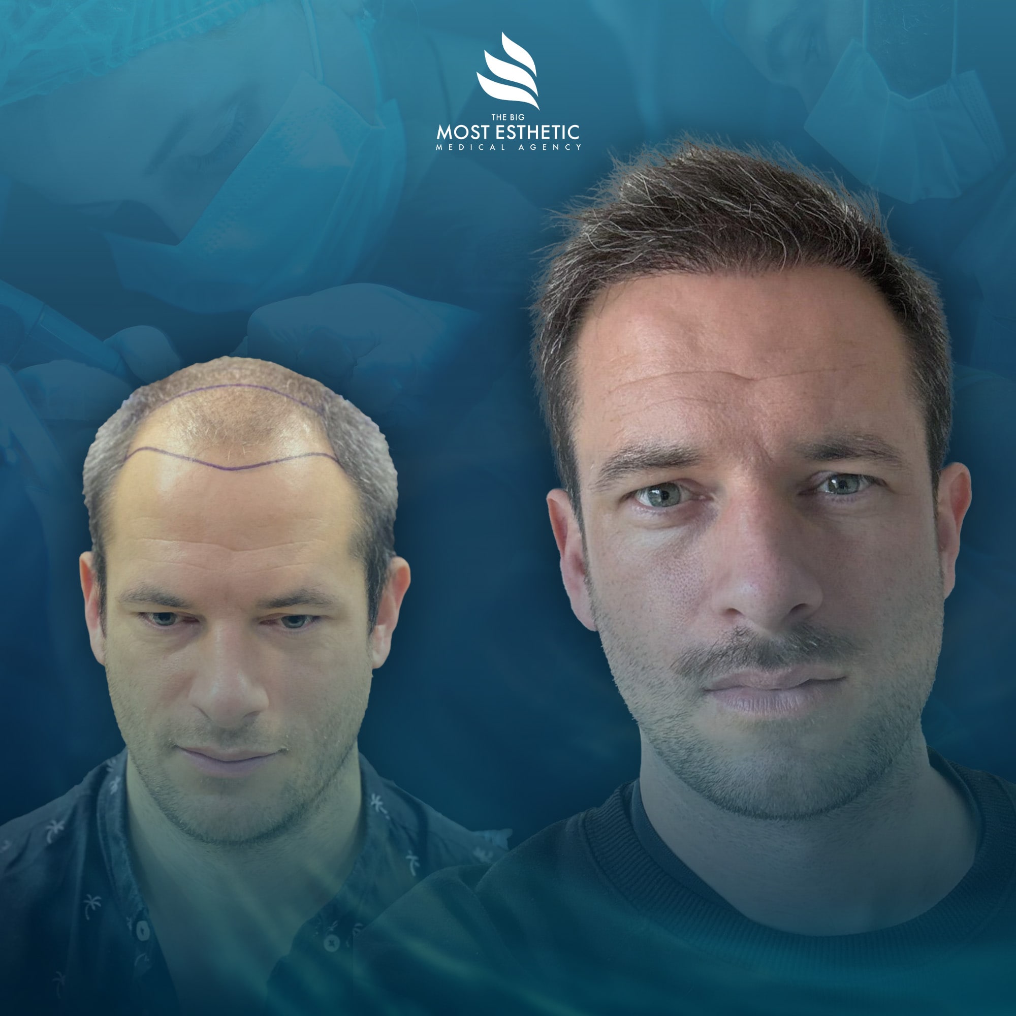 Frontal Density Enhancement