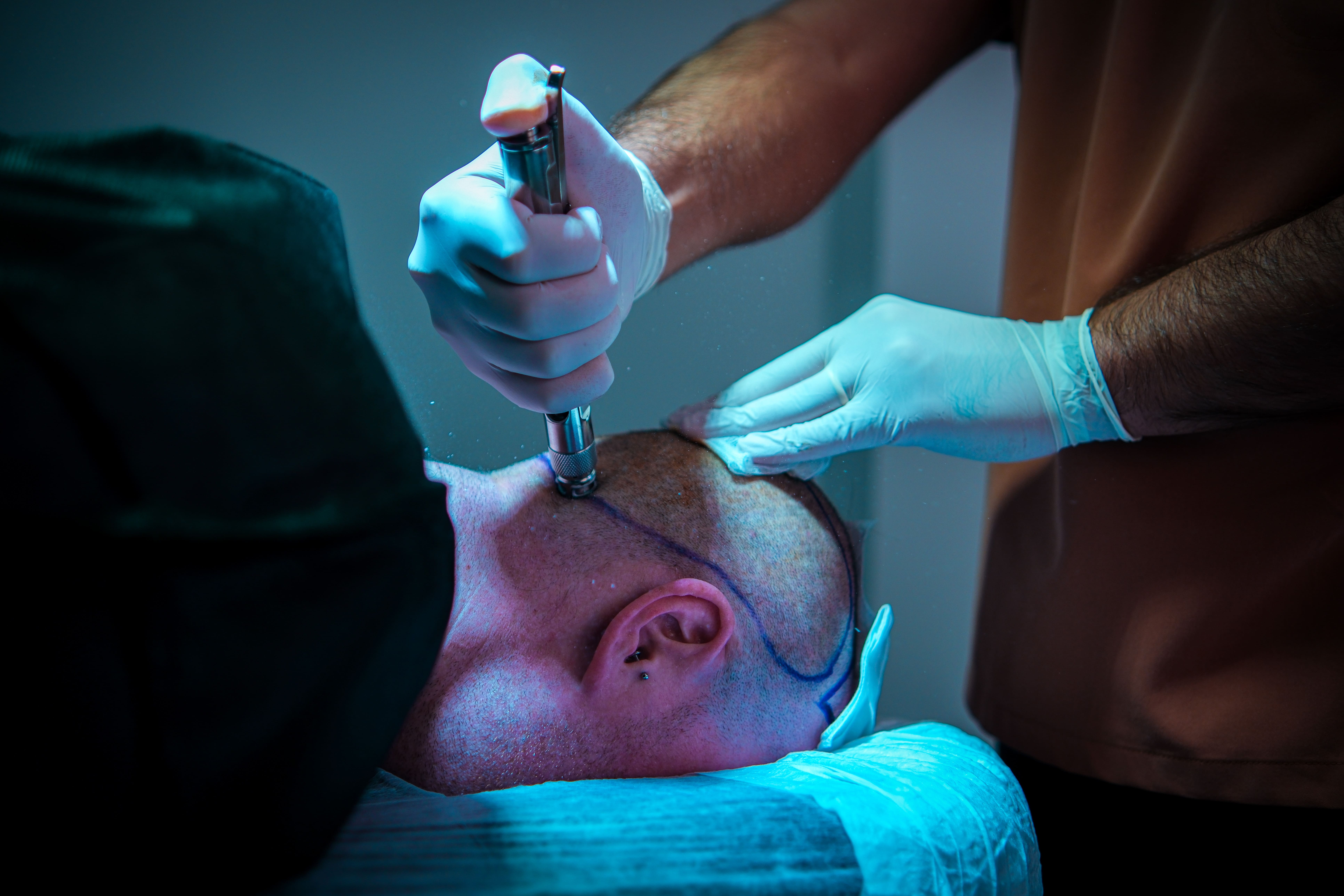 FUE Extraction Process